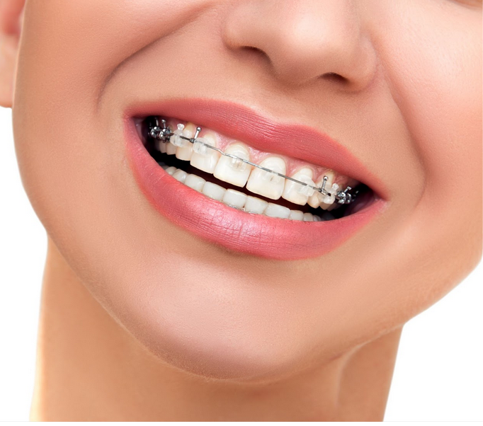 تقويم الاسنان الخزفي